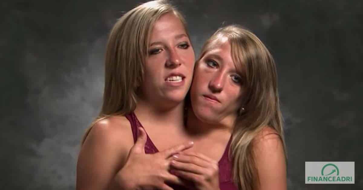 Siamese Twins Share Shocking News Years After Birth