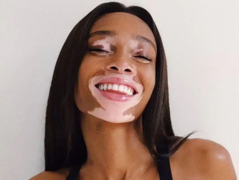 Winnie Harlow